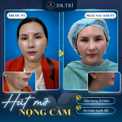 hut_mo_nong_cam
