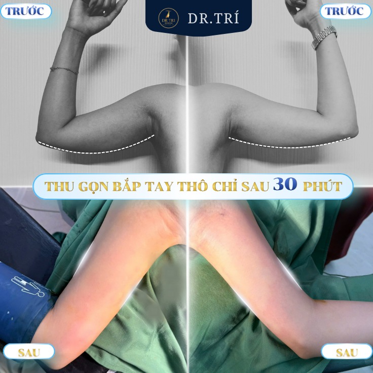 hut_mo_bap_tay