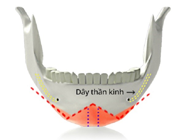phương pháp cắt xương hình w trong gọt hàm