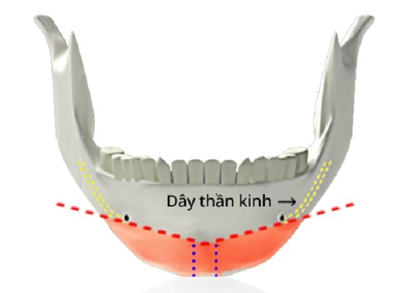phương pháp cắt xương chữ y trong gọt hàm vline