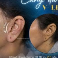 Căng Da Mặt Tái Tạo Dái Tai Biến Dạng: Cứu Cánh Cho Khách Hàng Sau Căng Da Hỏng Cùng TS.BS Đỗ Thành 
