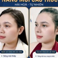 Nâng Mũi Cấu Trúc Toàn Diện Cùng TS.BS Đỗ Thành Trí – Đỉnh Cao Điêu Khắc Dáng Mũi Chuẩn Tỉ Lệ Vàng