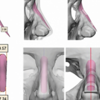 NÂNG MŨI BẰNG SỤN IN 3D CÁ NHÂN HÓA: BƯỚC TIẾN CÔNG NGHỆ KIẾN TẠO DÁNG MŨI ĐỘC BẢN