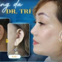 Căng Da Chỉnh Sửa Sẹo Lồi Cũ Cùng TS.BS Đỗ Thành Trí: Xóa Bỏ Di Chứng Thẩm Mỹ Hỏng, Tái Sinh Đường N