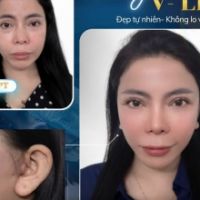 Vì Sao Nên Chọn Căng Da Mặt Tại Tiến Sĩ Trí? Đột Phá Kỹ Thuật Treo Cơ SMAS Tầng Sâu 