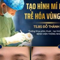 Tạo Hình Mi Dưới & Lấy Mỡ Bọng Mắt Ở Nữ: Trẻ Hóa Toàn Diện Đôi Mắt Cùng TS.BS Đỗ Thành Trí