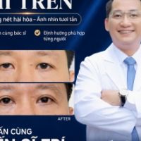 Tạo Hình Mí Trên Ở Nam Giới: Định Hình Ánh Nhìn Đĩnh Đạc, Nam Tính Cùng TS.BS Đỗ Thành Trí