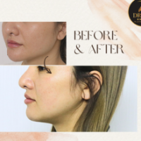 Gọt Hàm: Chìa Khóa Kiến Tạo Gương Mặt V-line Hoàn Hảo