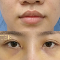Thu Nhỏ Cánh Mũi, Thu Nền Mũi Chuẩn Tỉ Lệ Vàng Cùng TS.BS Đỗ Thành Trí