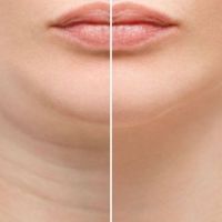 HÚT MỠ NỌNG CẰM TẠI THẪM MỸ VIỆN TIẾN SĨ TRÍ - XÓA CẦM ĐÔI TẠO MẶT V-LINE