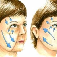 SO SÁNH CĂNG DA MẶT LỚP SMAS VÀ CĂNG DA CHỈ: VÌ SAO PHẪU THUẬT SMAS LÀ 