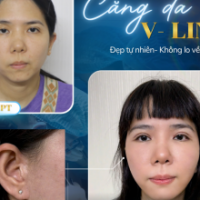  CĂNG DA MẶT BÁN PHẦN LÀ GÌ? GIẢI PHÁP TRẺ HÓA PHÂN VÙNG TẠI TS.BS ĐỖ THÀNH TRÍ