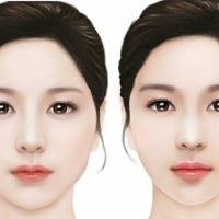 Hạ Gò Má Hay Lấy Túi Mỡ Má: Đâu Là “Cứu Cánh” Cho Khuôn Mặt Thanh Tú?