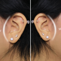 Căng Da Mặt Năm 2026: Đánh Thức 