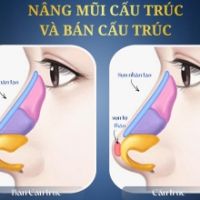 So Sánh Nâng Mũi Cấu Trúc Và Bán Cấu Trúc: Lựa Chọn Nào Hoàn Hảo Cho Bạn?