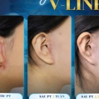 BIẾN CHỨNG CĂNG DA MẶT TẠI CƠ SỞ CHUI VÀ HÀNH TRÌNH 